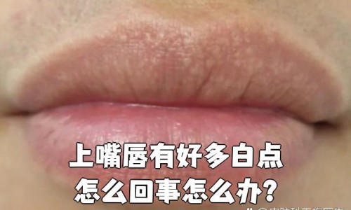 痦子可以涂抹药膏吗-瘊子外用药可以治愈吗网 - 网站提供痦子可以涂抹药膏吗小常识、治疗痱子的外用药物